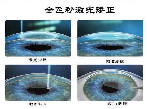 近视党必看 | 全飞秒SMILE激光和ICL人工晶体植入术，到底该选谁？