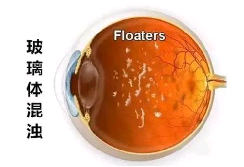 玻璃体混浊的各种症状表现